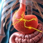 extrasystoles dues a l'estomac